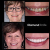 Vieille femme avec blanchiment des dents Photos avant et après - Blanchiment des dents Diamond Smile