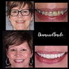 Femme âgée Avant Après Photos de PAP+ Gel de blanchiment des dents de Diamond Smile