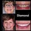 Résultat Diamond Smile Blanchiment des dents Correction de la couleur Mousse - Avant Image Après Image de dents blanches