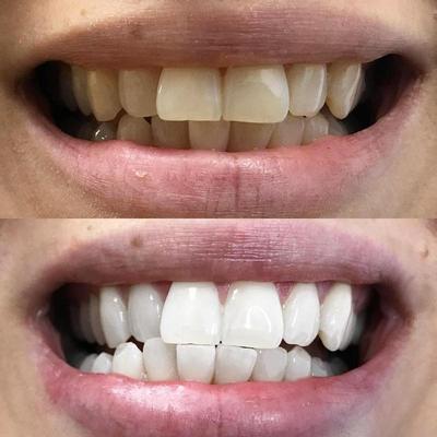 Blanchiment des dents pour des dents blanches. Sur l'image, une photo avant après de dents après le blanchiment.