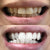 Blanchiment des dents pour des dents blanches. Sur l'image, une photo avant après de dents après le blanchiment.