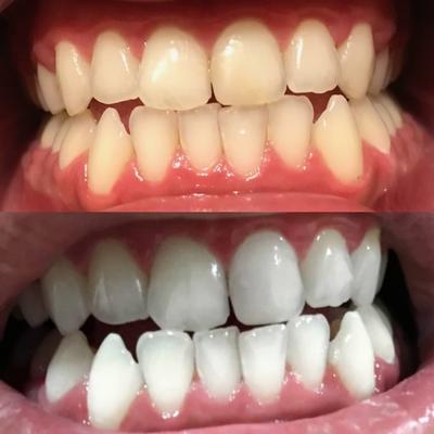 Des dents blanches après avoir été blanchies avec un kit de blanchiment dentaire et un gel de blanchiment dentaire.
