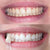 Des dents blanches grâce au blanchiment des dents. Photos d'une femme après le blanchiment des dents.