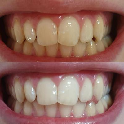 Dents blanches et jaunes. Dents blanches après blanchiment des dents avec un gel de blanchiment dentaire. Blanchiment des dents grâce au blanchiment des dents.