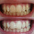 Dents blanches et jaunes. Dents blanches après blanchiment des dents avec un gel de blanchiment dentaire. Blanchiment des dents grâce au blanchiment des dents.