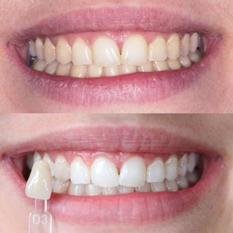 Expérience de blanchiment des dents Diamond Smile - Femme avec photo avant/après de dents blanches