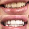 Expérience de Diamond Smile Stylo de blanchiment des dents violet Correction de la couleur - Bouche avec image avant et image après de dents blanches