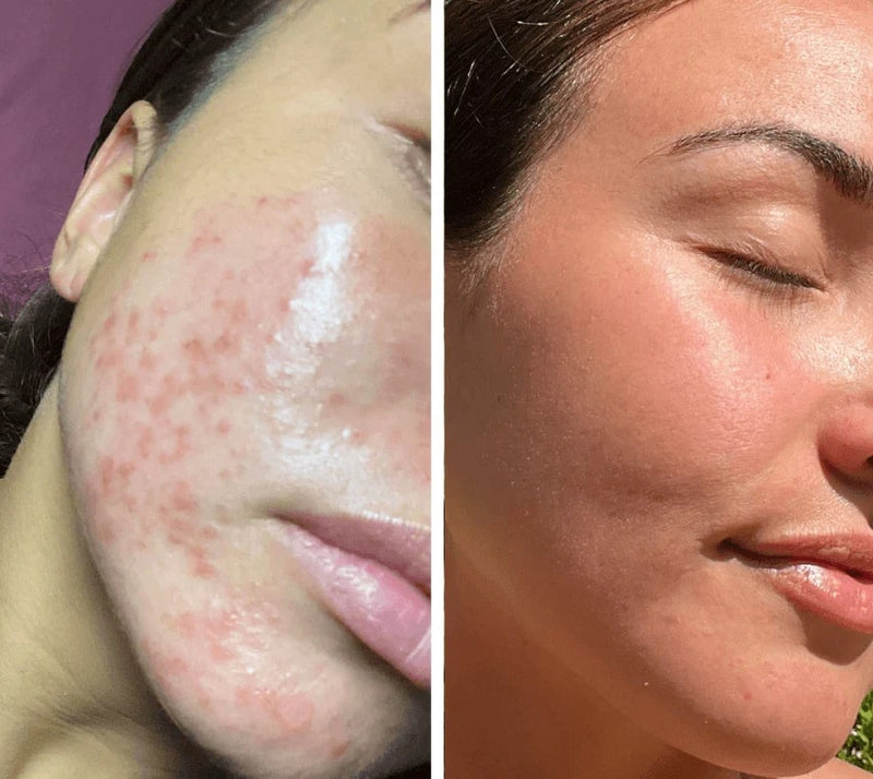 Masque de luminothérapie LED LUMIDARK