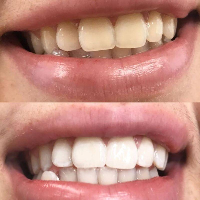 Expérience de la brosse à dents sonique Power LED Bleaching de Diamond Smile avec image avant et après blanchiment des dents