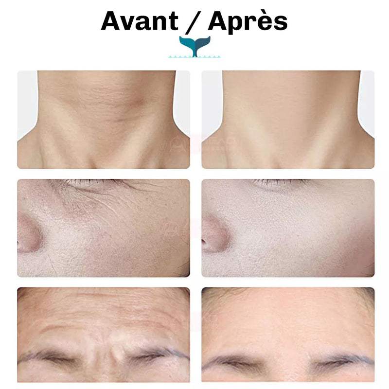 Appareil soin visage EMS Diamond stimulation musculaire