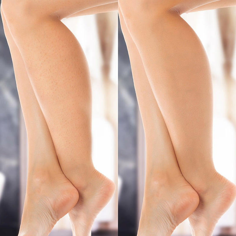 Epilateur IPL Diamond peau douce durable