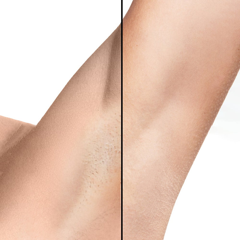 Epilation longue duree Diamond peau lisse