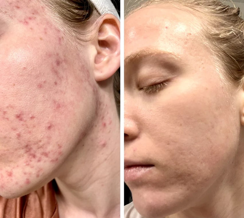 Masque lumiere rouge visage Diamond stimulation collagene