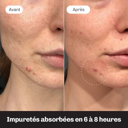 Patch acne transparent Diamond discret sur peau