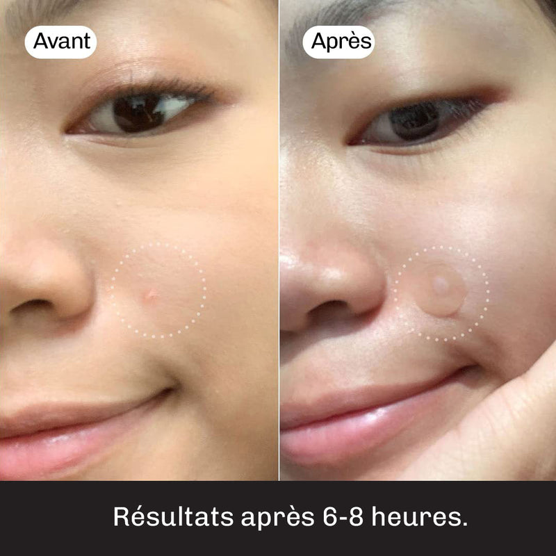 Patch bouton Diamond utilisation jour et nuit