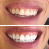 Strips de blanchiment des dents pour des dents blanches