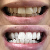 Blanchiment des dents par bandes de blanchiment dentaire