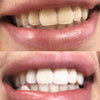 Des dents blanches et lumineuses grâce au blanchiment des dents Diamond