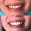 Expérience de Diamond Smile Blanchiment des dents Mousse de correction de couleur violette - Bouche avec image avant et image après de dents blanches