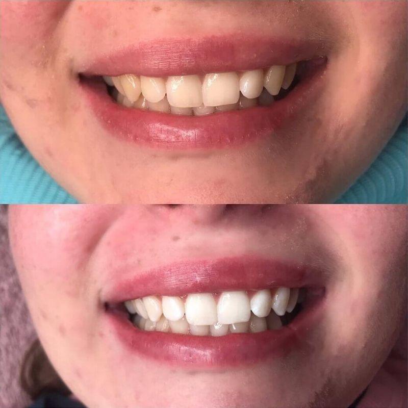 Expérience de Diamond Smile Blanchiment des dents Mousse de correction de couleur violette - Bouche avec image avant et image après de dents blanches