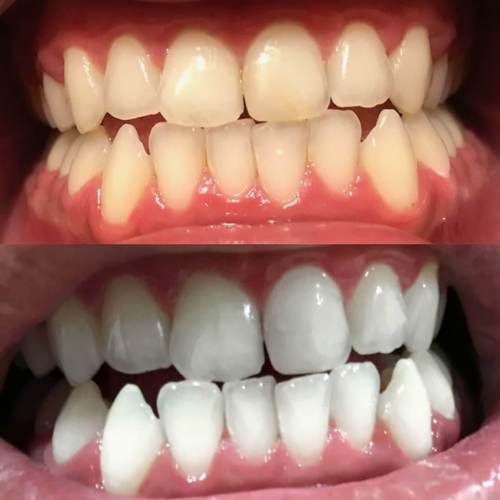 Expérience Avant Après Photos du dentifrice blanchissant PAP+ de Diamond Smile