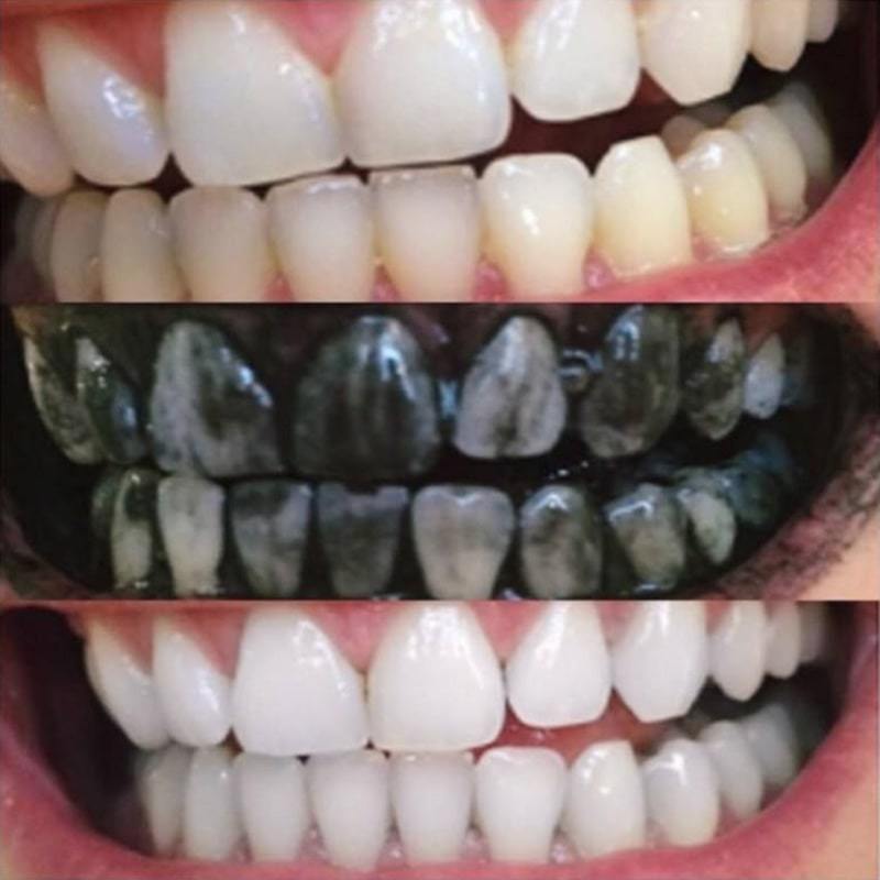 Expérience de Diamond Smile Blanchiment des dents Poudre de charbon actif - Bouche avec image avant et image après de dents blanches