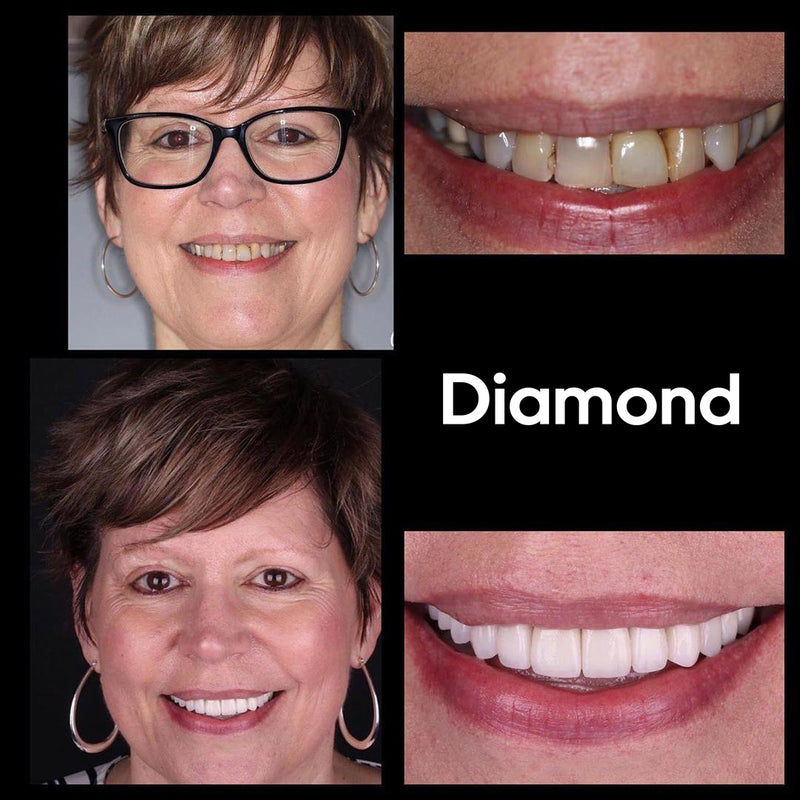 Résultat Diamond Smile Blanchiment des dents Correction de la couleur Mousse - Avant Image Après Image de dents blanches